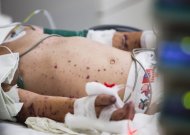 Meningokokinė infekcija pavojingiausia vaikams iki penkerių metų