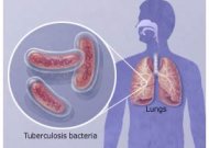 Jurbarko moksleivei diagnozuota atvira tuberkuliozės forma (ką apie šią ligą reikia žinoti)